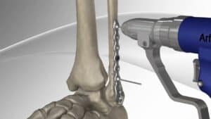 prelom kosti operacija fraktura kosti operacija