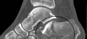 ct skener prelom kosti prelom petne kosti