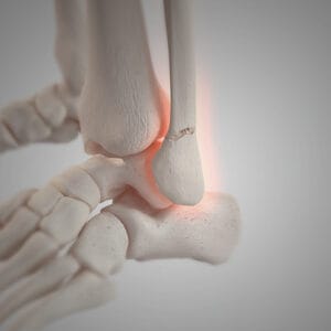 prelom skočnog zgloba