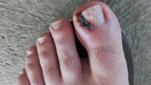 urasli nokat neuspešan pedikir uraslog nokta