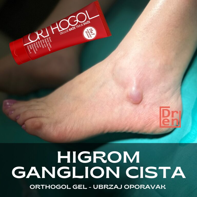 higrom ganglion cista mrtva kost MKB M67.4