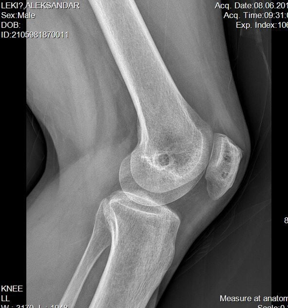 dr dren mpfl operacija kolena za ponavljajuće iščašenje čašice