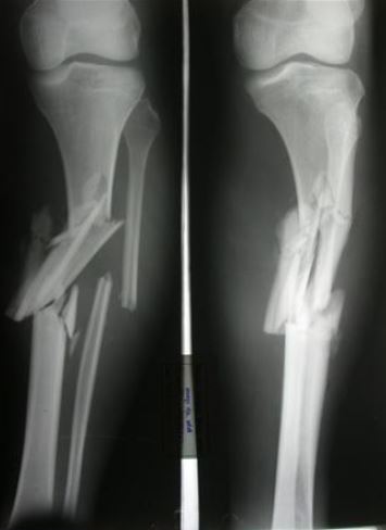 prelom potkolenice gips operacija