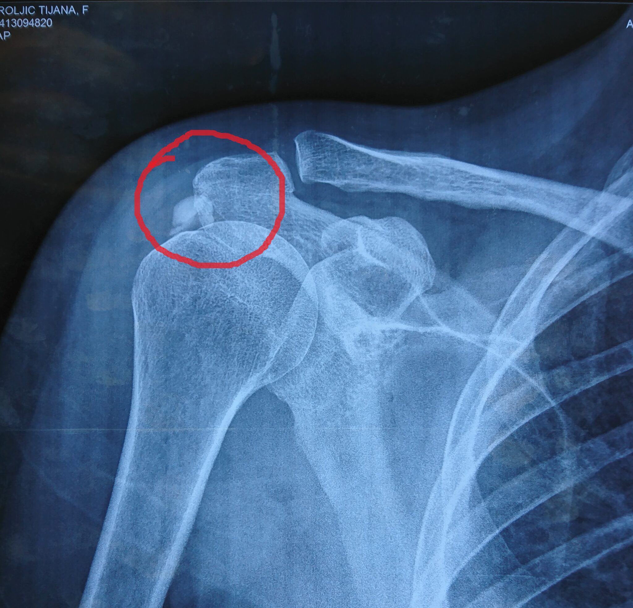 Kalcifikacija ramena Kalcifikat u ramenu pre operacije - Dr Dren