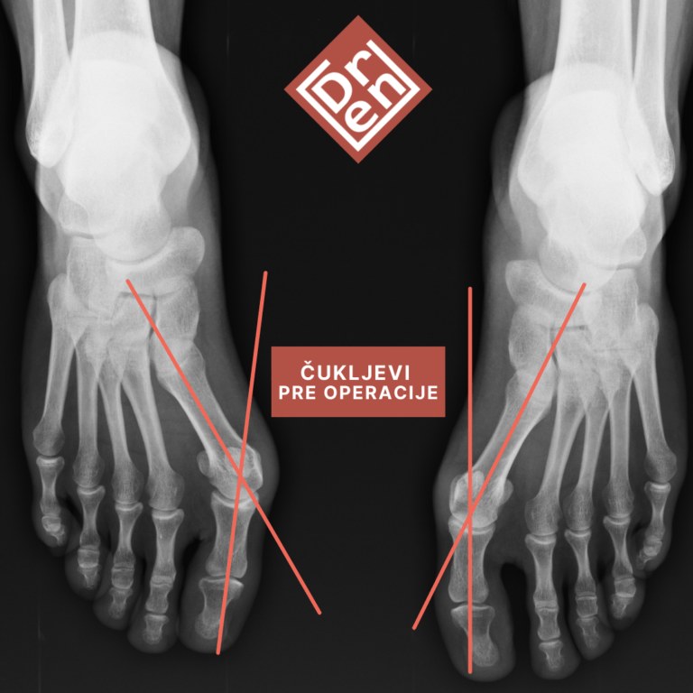 čukalj hallux bunion kako izgleda kako se leči