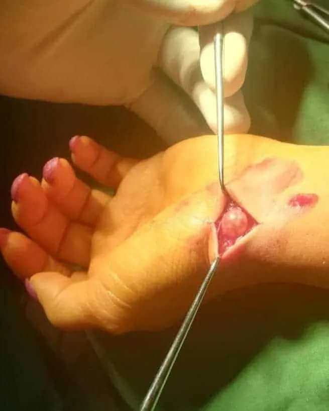 higrom na ručnom zglobu