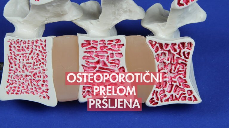 osteoporotični prelom pršljena i prelom kuka lečenje osteoporoze