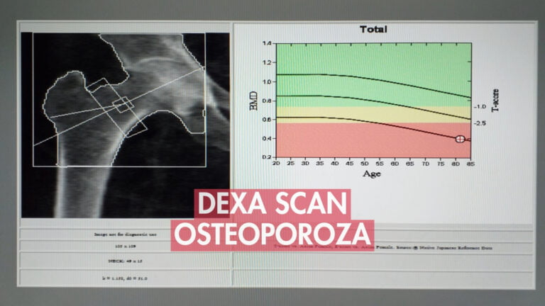 osteoporoza dijagnoza dexa dxa scan skeniranje