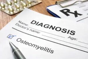 osteomijelitis osteomyelitis infekcija kosti