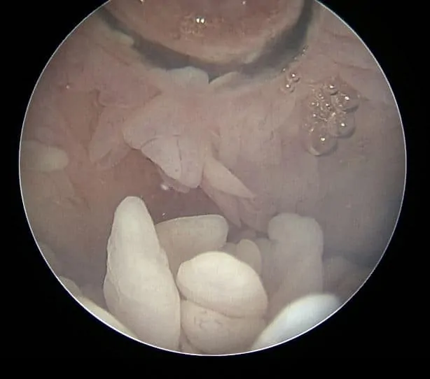 sinovitis kolena artroskopija 1