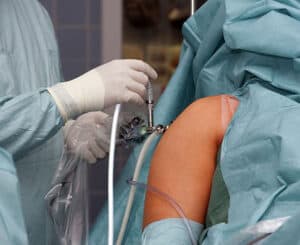 artroskopija ramena stabilizacija ramena bol u ramenu iščašenje ramena