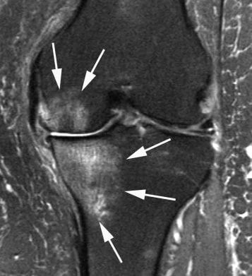 MR snimak gonartroze kolena kao jedan od razloga za artroplastiku kolena