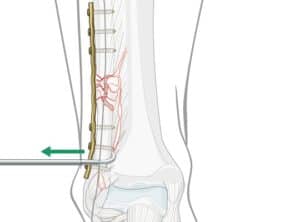 operacija preloma skočnog zgloba