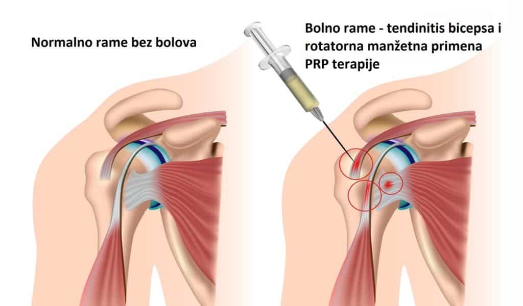 prp terapija kolena cena ramena kuka tetive - Dr Dren prp terapija kolena cena ramena kuka tetive