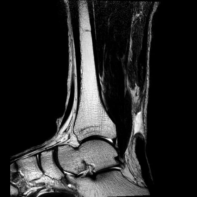 ruptura ahilove tetive mri - Dr Dren ruptura ahilove tetive mr magnetna rezonanca