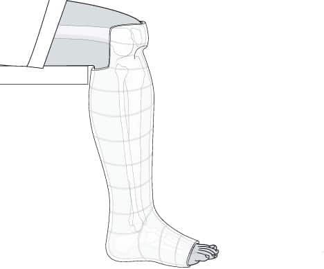 potkoleni gips za hod sarmiento