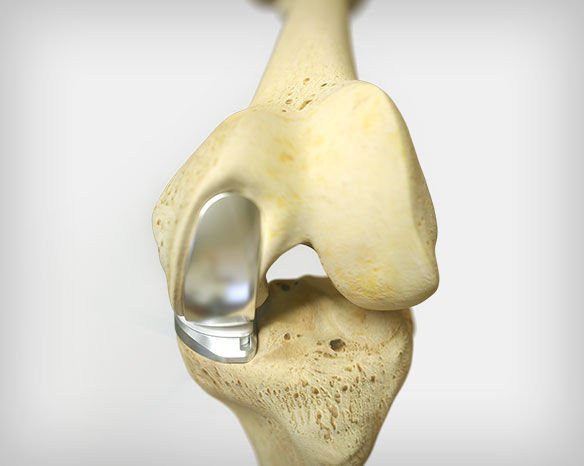 uni proteza kolena parcijalna proteza kolena