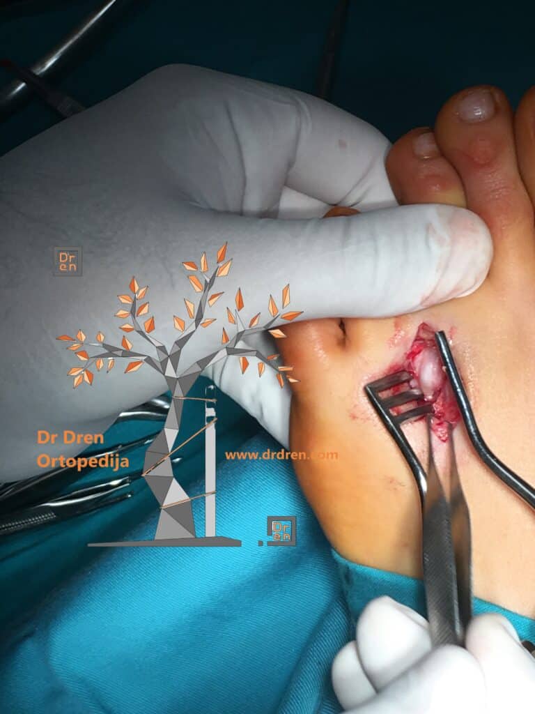 mortonov neurom operacija