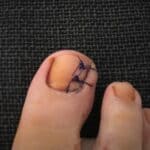 urasli nokat dva dana posle operacije