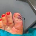 kako izgleda operacija uraslog nokta