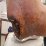 gangrena stopala