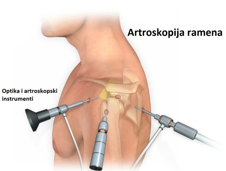 artroskopija ramena bol u ramenu nestabilnost artroskopska operacija stabilizacija ramena