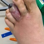 gangrena stopala dijabetes