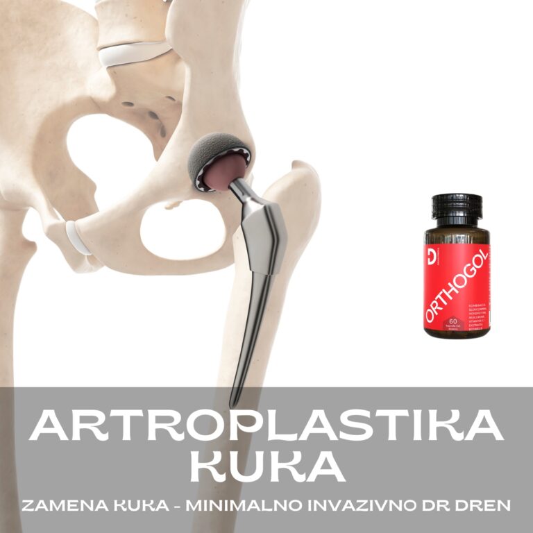 artroplastika kuka zamena kuka operacija kuka endoproteza veštački kuk iskustva oporavak keramički bescementni kuk koksartroza