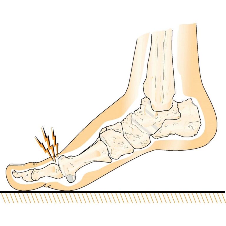 hallux rigidus m20.2 ukrućen ukočen palac bol u palcu stopala lečenje terapija