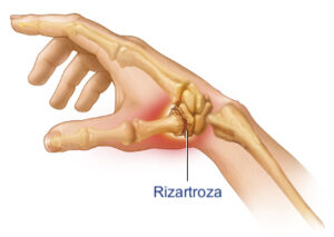 rizartroza