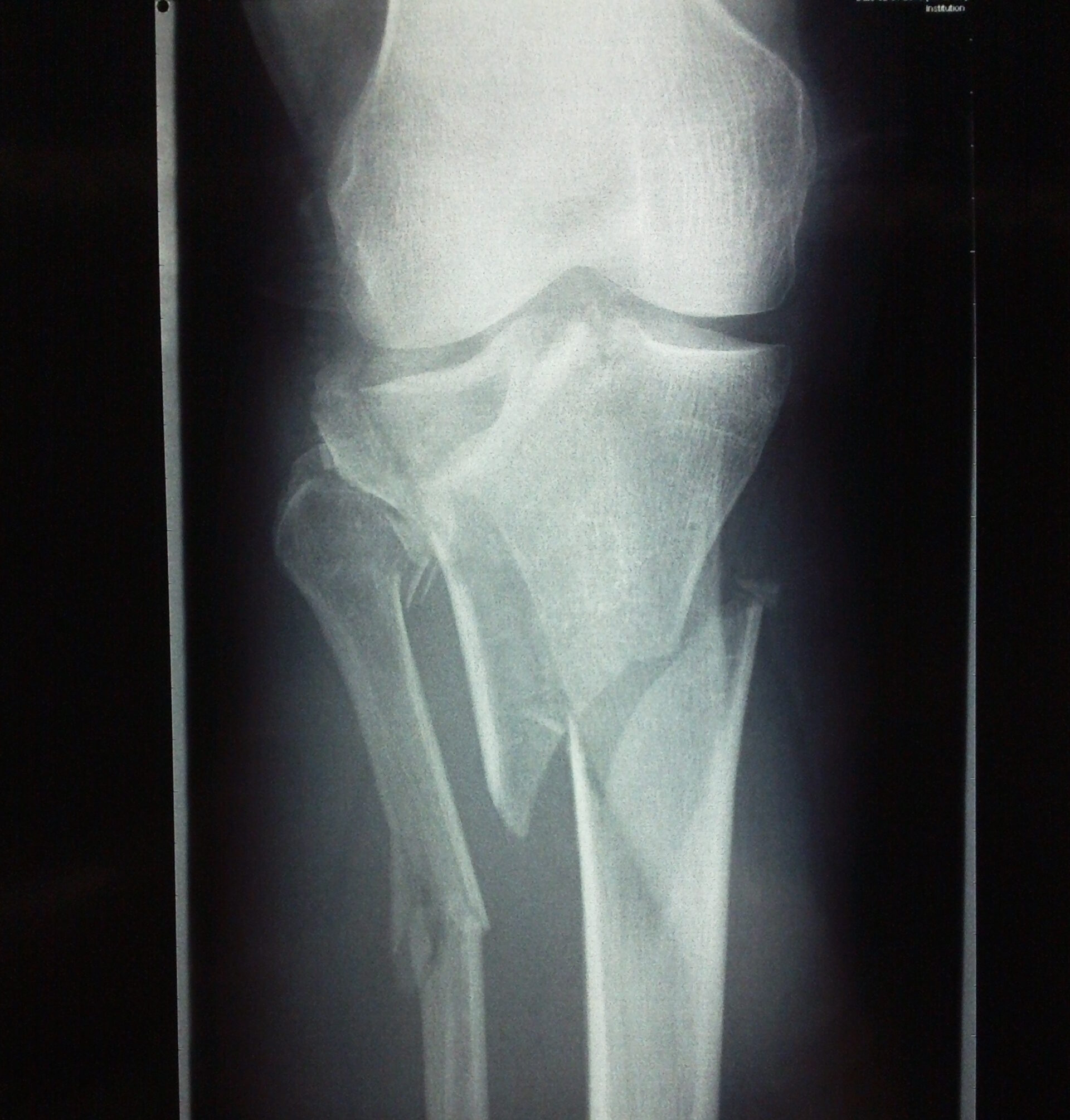 prelom platoa tibie platotibijalni prelom