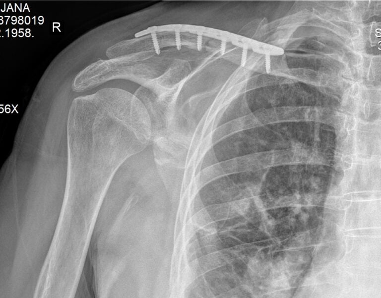 prelom klavikule POSLE operacije nezaraslog preloma ključne kosti u Dr Dren