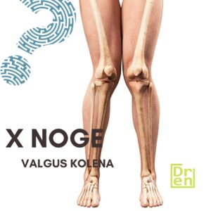 krive noge kriva kolena x noge o noge kako se korigiuju operacija ispravljanje nogu