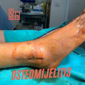 osteomijelitis stafilokoka stafilokokus pseudomonas klebsiella acinetobacter streptokok escherichia