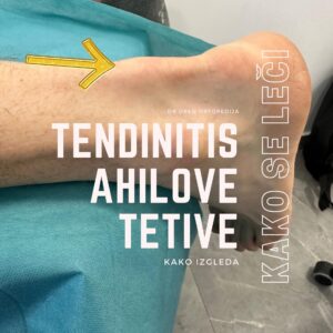 Tendinitis upala ahilove tetive