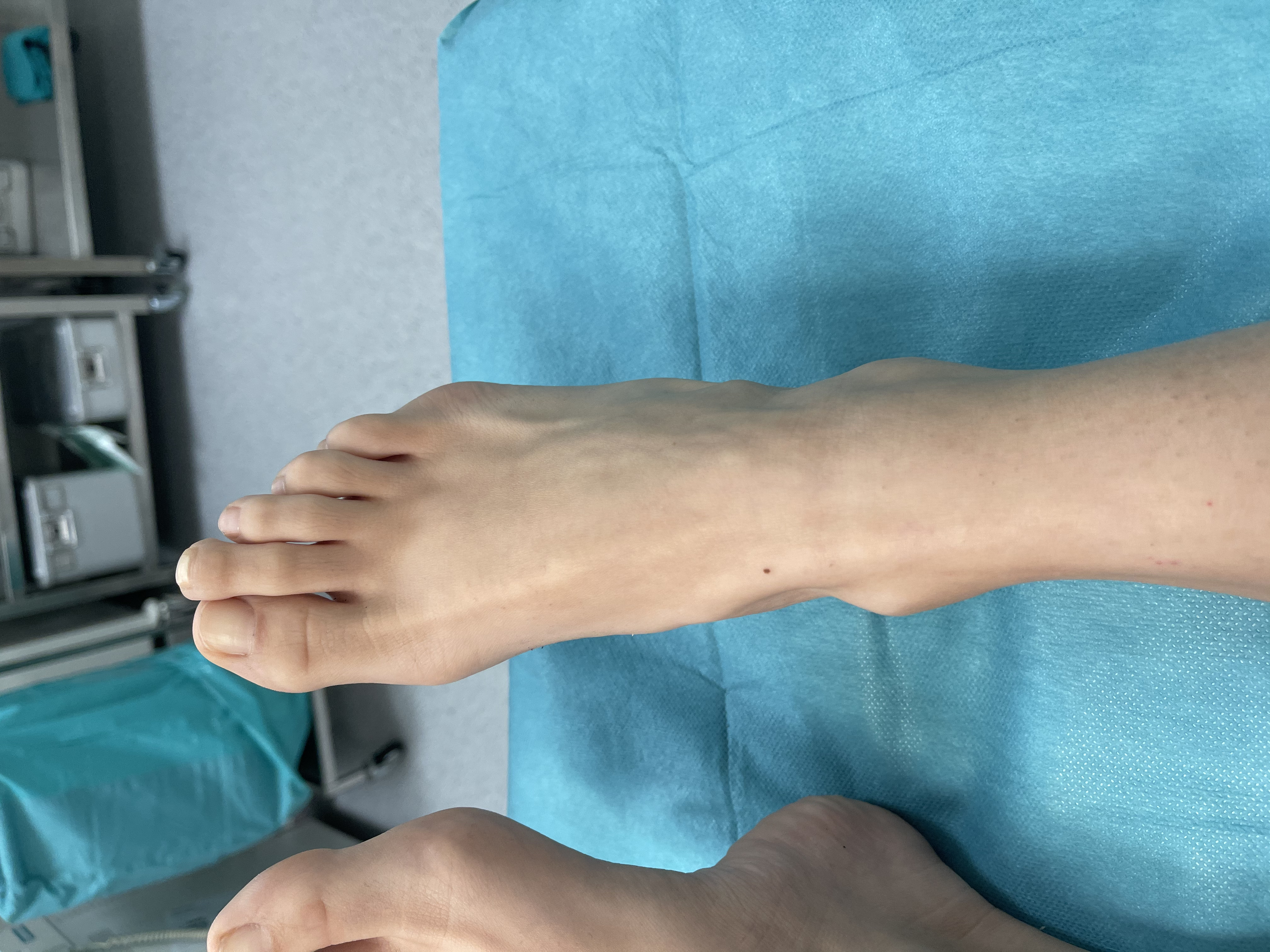 Mortonov prst grčko stopalo cinderella operacija surgery skraćenje prsta Dr Dren