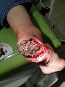 gangrena noge gangrena pete