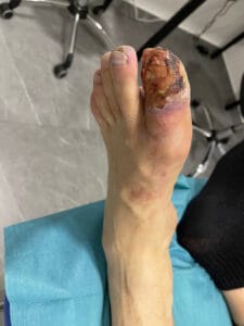 gangrena noge slike gangrena prsta palca stopala