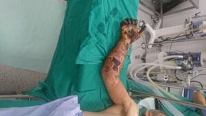 gangrena ruke gangrena šake