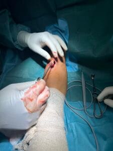 Dr Dren operacija bicepsa