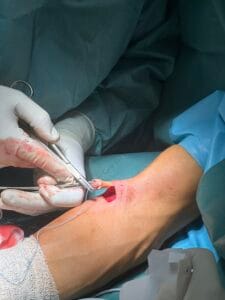 Dr Dren operacija bicepsa