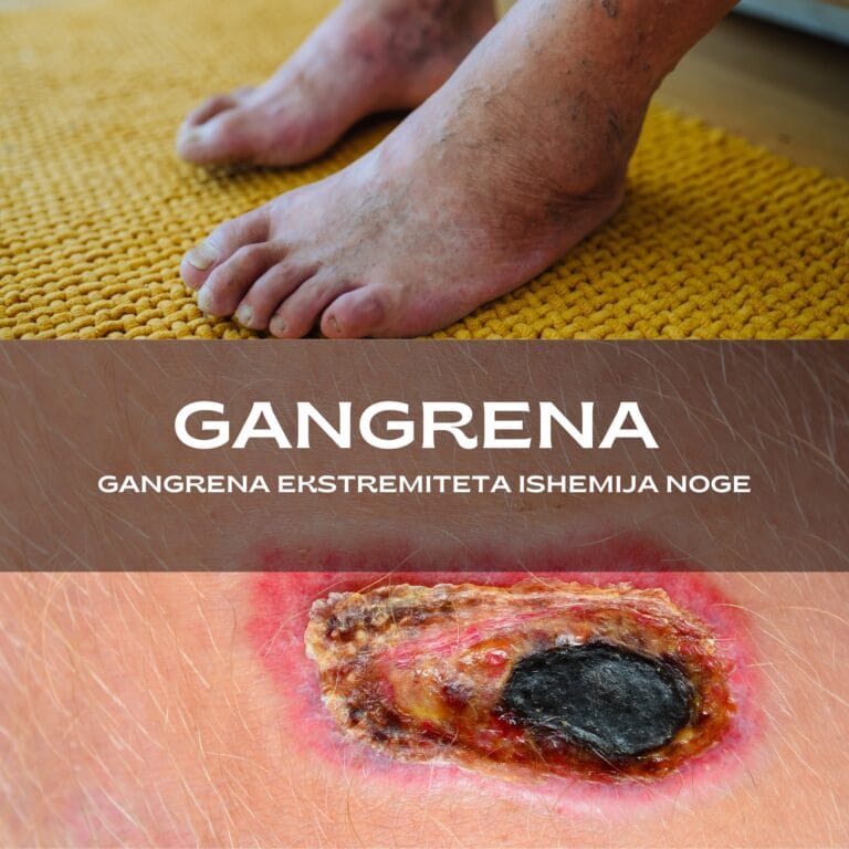 gangrena noge, gangrene, gangrena nogu slike, prvi simptomi gangrene, kako izgleda gangrena, gangrene prsta, gangrene nogu, gasna gangrene, prvi simptomi gangrene na nozi