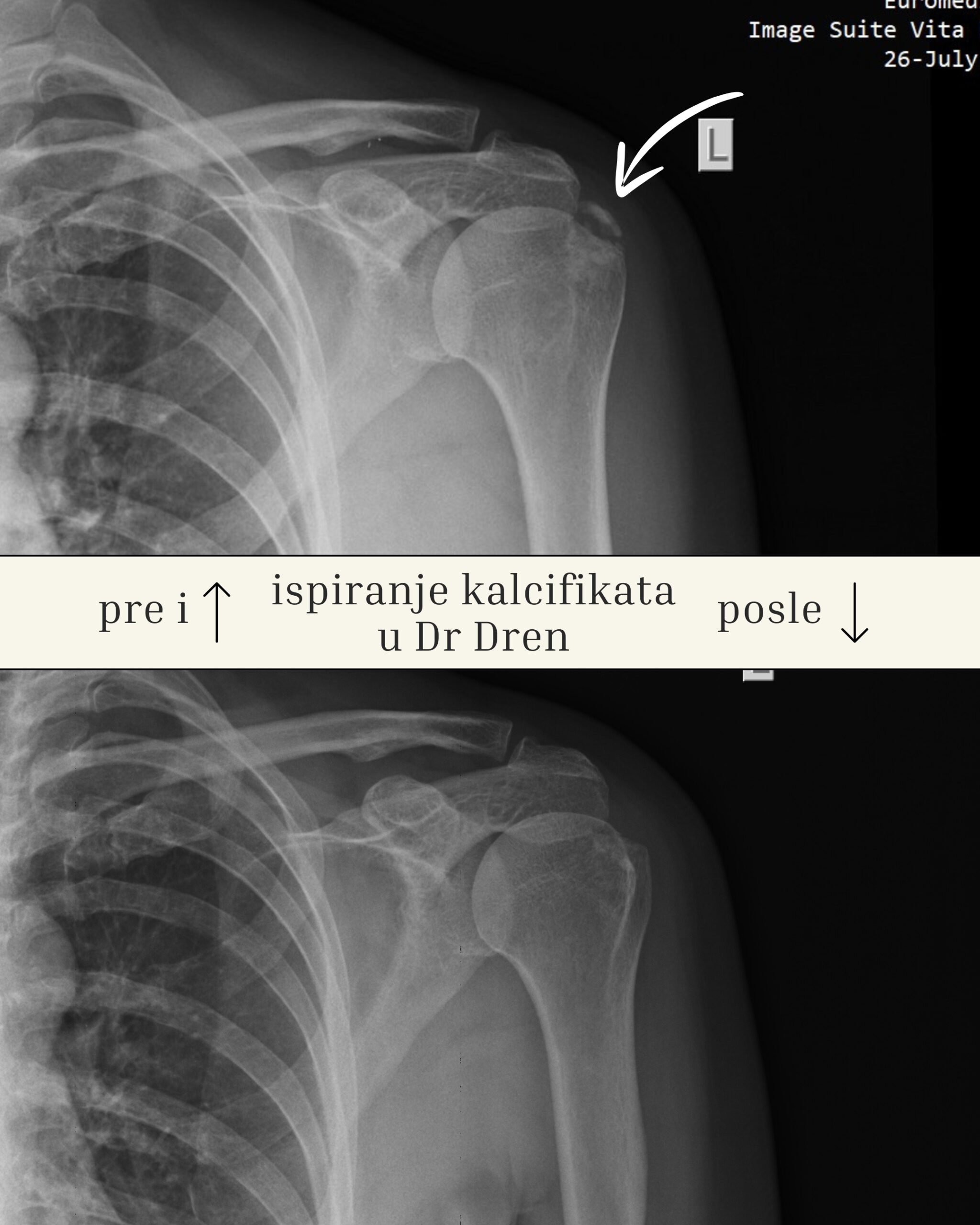 barbotage ispiranje kalcifikata pod ultrazvukom Dr Dren slika pre i posle ispiranja