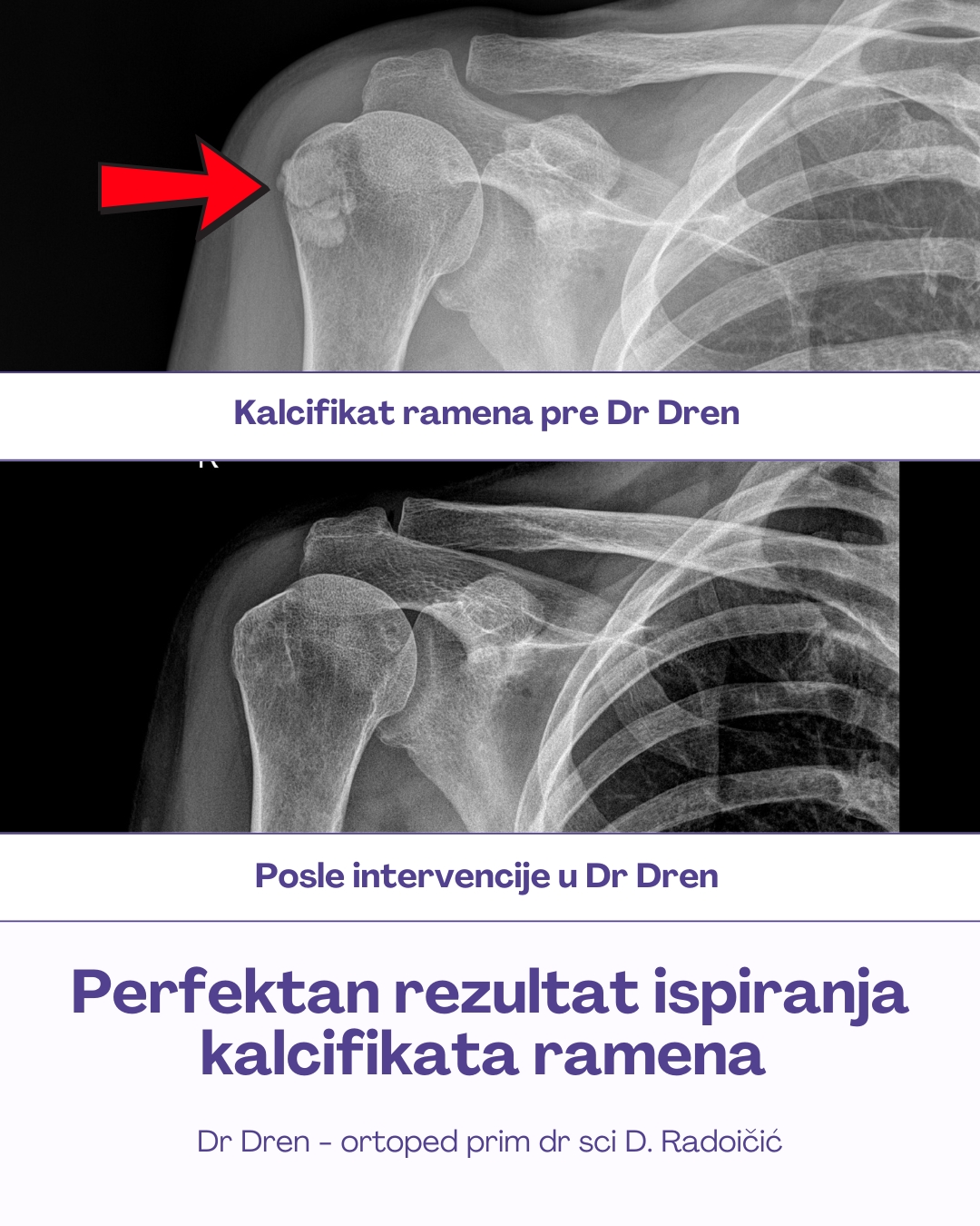 kalcifikat ramena ispiranje barbotage lokalna anestezija uspešno uklonjena kalciofikaciaj ramena pre i posle snimak
